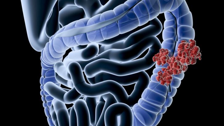 colon cancer in young adults